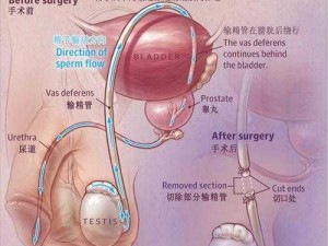 tubectomy vasectomy：结扎手术对男女健康有哪些影响？