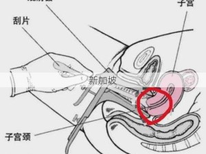 专家解析：14厘米长物品能否安全进入宫颈及相关宫颈问题